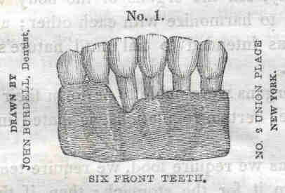 Six Front Teeth, Four Receded by Tobacco